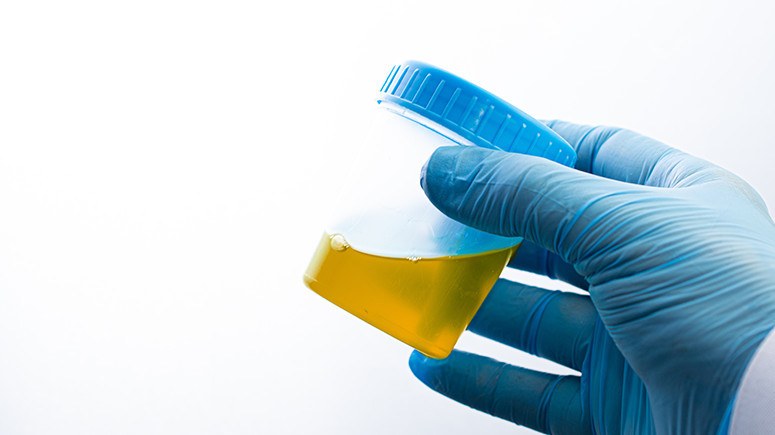 dark yellow urine